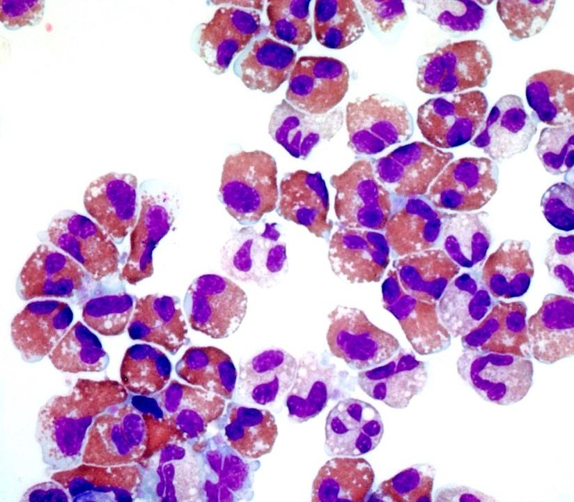 Eosinophilic leukaemia in a patient
