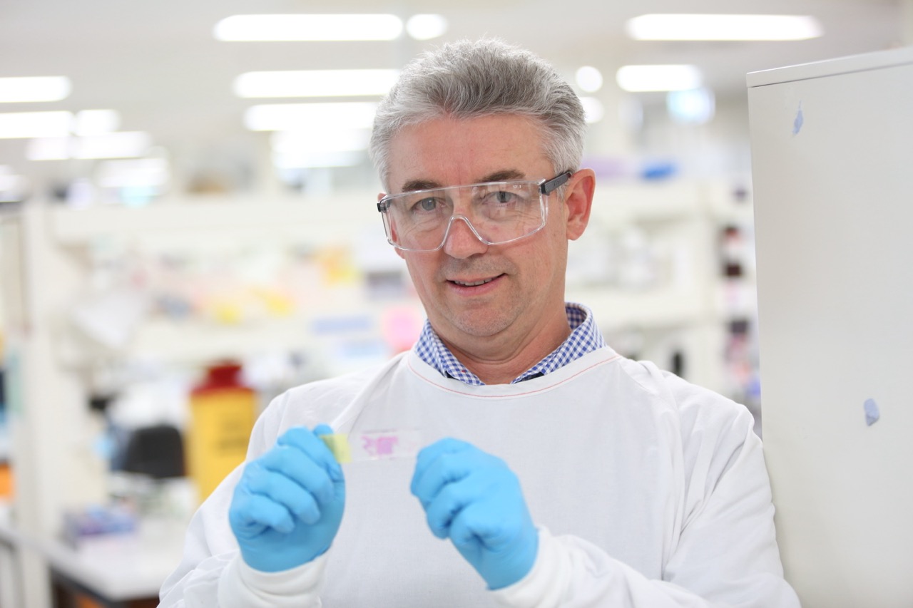 Game-changing blood test to detect bowel cancer